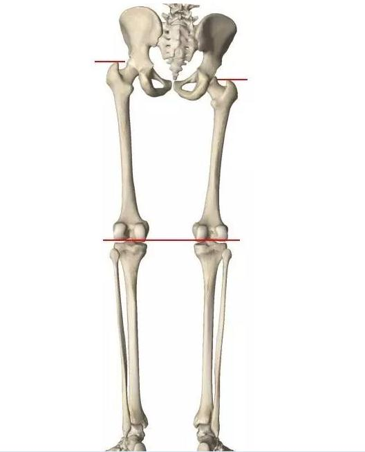 结构性下肢不等长:下肢骨骼(股骨或胫骨)长度不一致造成的,是一种骨