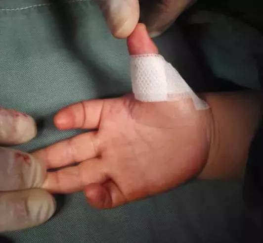 宝宝才1岁,大拇指就直不起来了!医生说这病大人最爱得