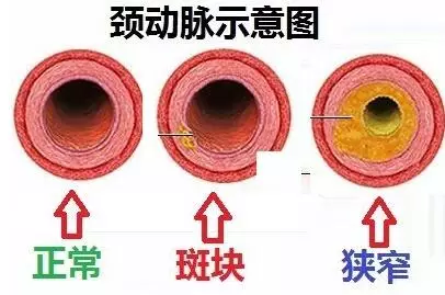 脑血管疾病,根源出现在哪里?