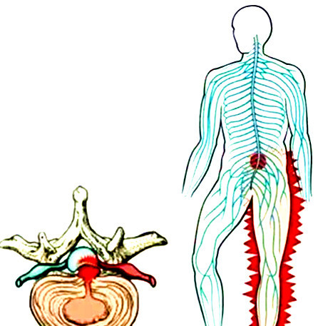 出现这些情况,你的腰椎间盘突出已经很严重了!