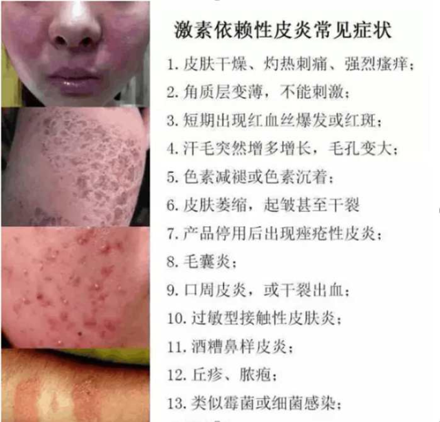 皮肤管理公开课: 激素脸和过敏脸如何分辨?