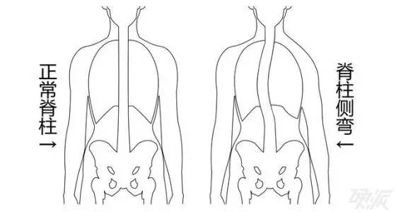 高低肩的4大危害,幸好有矫正方法