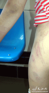 九岁女童遭受继母虐待 满身伤痕向邻居求救(图)