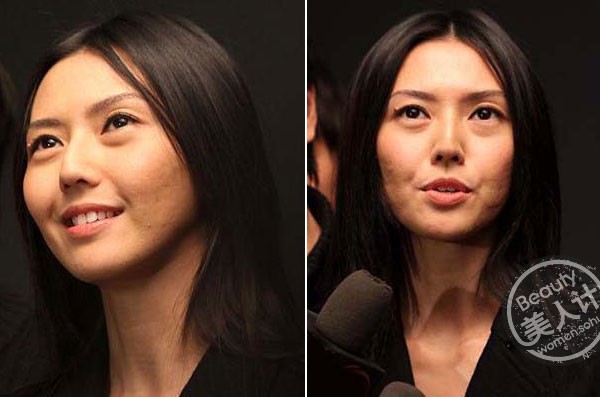 孙燕姿痘坑满脸皮肤粗糙 清痘妙招要早学(组图)