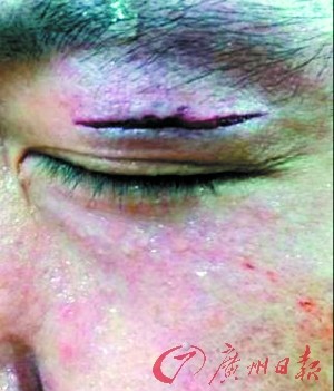 王治郅备战全运会眼部受伤缝10针 触目惊心(图)