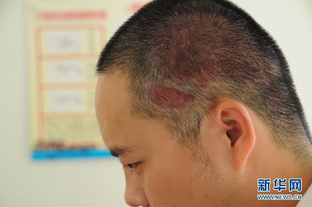 高清:"中国好兄弟"争相割皮救父 哥哥再度手术(组图)