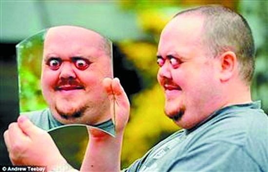 男子双眼凸出12毫米能"变焦" 奇人异事大盘点/图