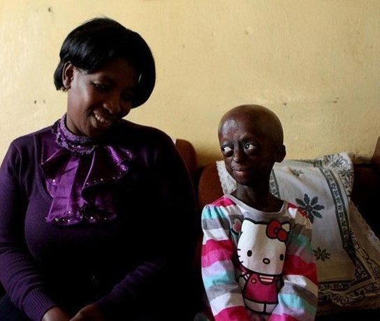 解读儿童早衰症 那些未老先衰的孩子们【组图】