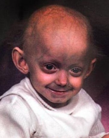 解读儿童早衰症 那些未老先衰的孩子们【组图】