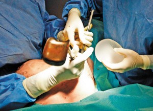 乳房手术全过程 整形图片