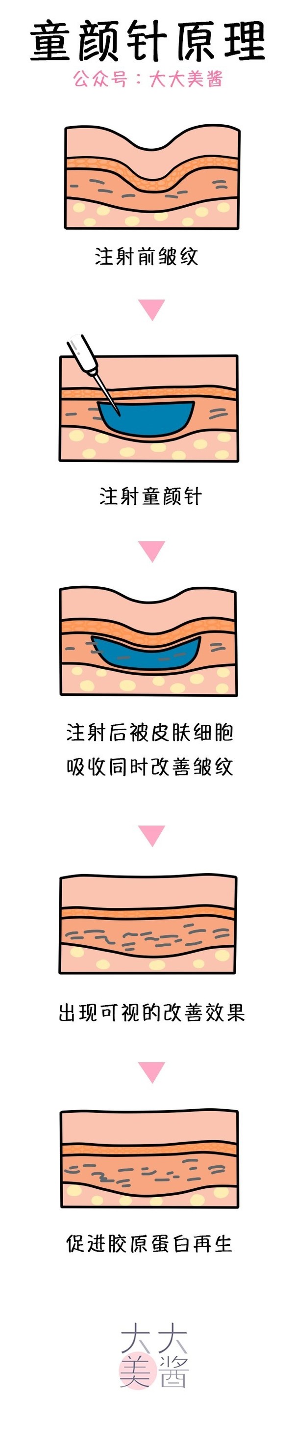 美肤项目科普篇 童颜针 王菲打的那么贵的抗衰老 时尚频道 手机搜狐