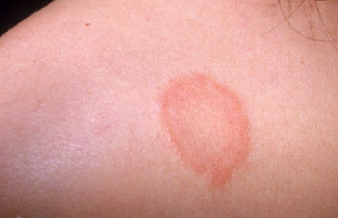 金钱癣能治好吗 中医偏方彻底根除 财经频道 手机搜狐