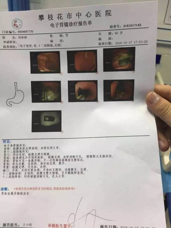 胃镜检查显示,刘某腹部有异物
