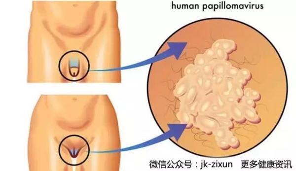 尖锐湿疣反反复复发作治愈难 公共马桶会传染吗 健康频道 手机搜狐