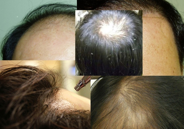 食疗只能通过内在调理,外在与头皮直接接触的油脂性脱发主要是头发