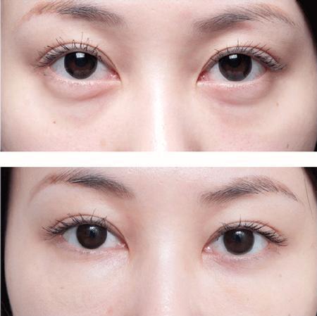 害怕眼袋手术失败 原因及修复方法都在这里 健康频道 手机搜狐