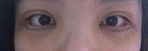 害怕眼袋手术失败 原因及修复方法都在这里 健康频道 手机搜狐