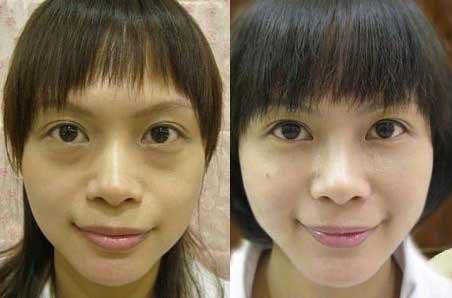 害怕眼袋手术失败 原因及修复方法都在这里 健康频道 手机搜狐