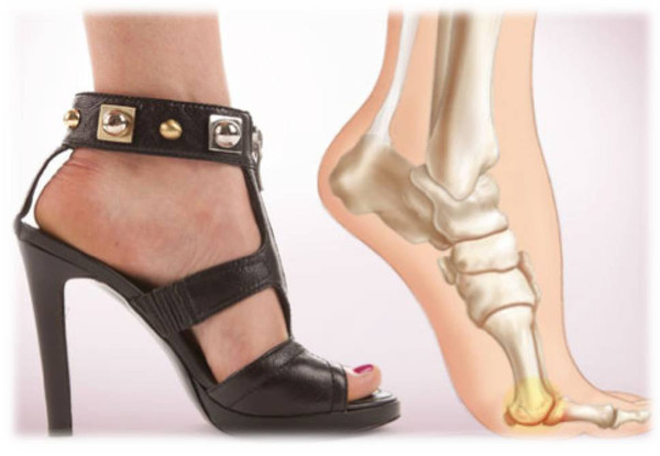 拇外翻又称大脚骨,是指拇趾向外偏斜超过正常生理角度的一种足部畸形