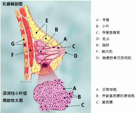 乳腺3期浸润性导管癌诊疗指南 新闻频道 手机搜狐