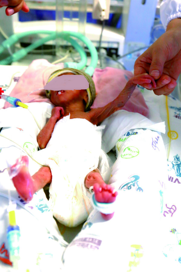 【救死扶伤】26周早产儿,体重仅850克,被医务人员想方设法救了回来