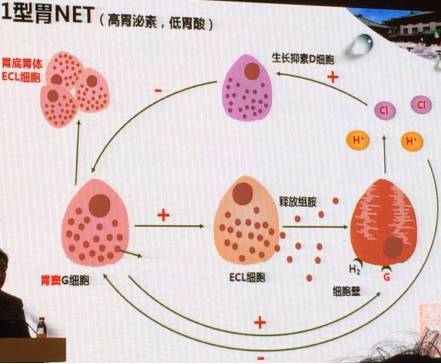 华北五省市消化会议|胃神经内分泌肿瘤(net)新分型指南解读(上)