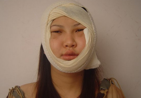 韩国女生整容全过程,刚整完的样子,简直没法看!