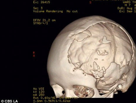 3d 打印超仿生头盖骨 帮助7 岁小孩重获生命力 科技频道 手机搜狐