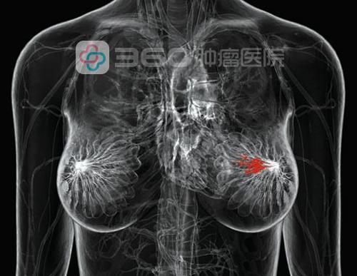 乳腺癌手术详解 患者先吃一味定心丸吧 健康频道 手机搜狐