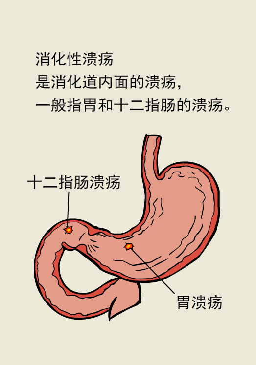 寒冷的冬季,警惕消化道溃疡