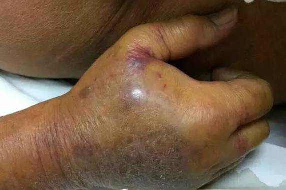食肉菌致死率非常高,可通过皮肤小伤口进入人体内,市