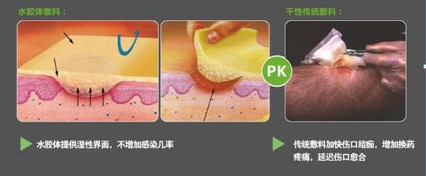 水胶体敷料 敷料界最常使用的敷料之一 健康频道 手机搜狐