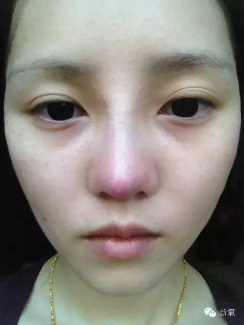 林允这样的塌鼻梁,做个线雕隆鼻会好看吗?