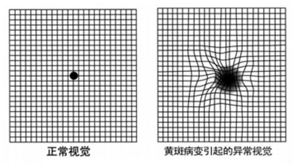 眼底黄斑为什么容易病变呢 健康频道 手机搜狐