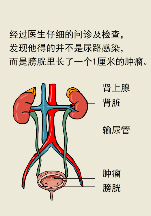 遇到血尿要警惕,莫要遺漏膀胱癌