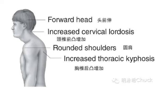 圆肩驼背怎么破 上交叉综合征的矫正方法汇总 健康频道 手机搜狐