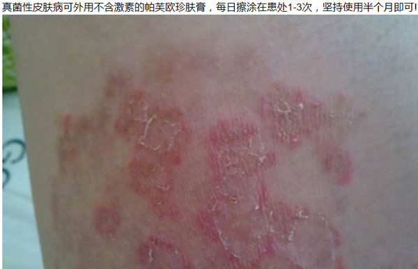 真菌性皮肤病的治疗 小偏方成为好方法 健康频道 手机搜狐