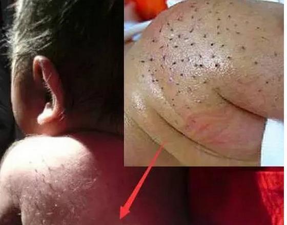 宝宝身上出现整片黑色毒刺 睡不着竟然是它在搞鬼 新闻频道 手机搜狐