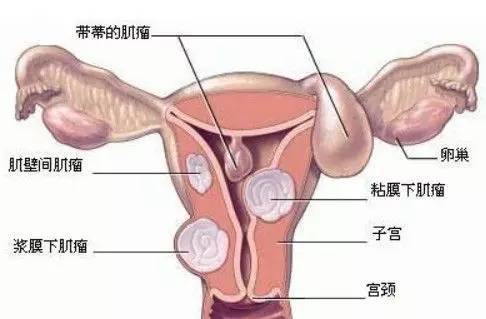 女性养生 子宫肌瘤 谁割谁后悔 为什么呢 时尚频道 手机搜狐