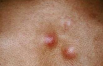 早期淋巴癌也会转移