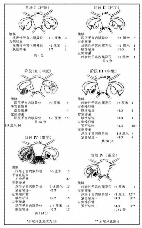 子宫内膜异位症到底是怎么回事?