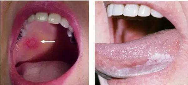 得了舌癌 正确的治疗方案以及各自优缺点 健康频道 手机搜狐