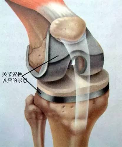 全膝关节置换术并不可怕术后病人可恢复行走 健康频道 手机搜狐