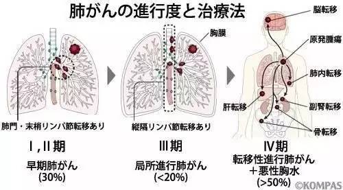 肺癌真的是抽烟导致的吗 一文让你认清肺癌 健康频道 手机搜狐