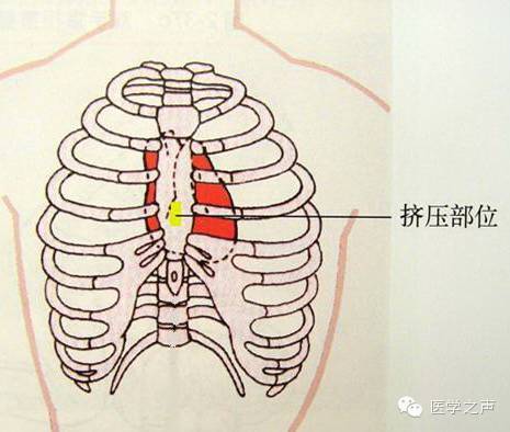 胸外心脏按压 这10点细节要注意 健康频道 手机搜狐