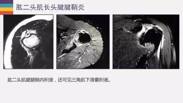 肱二头肌长头腱病变的mr诊断