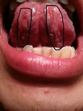 舌头底下有小红点图片图片