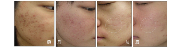 化妆品没效果?1550点阵激光抗衰技术给您新希望