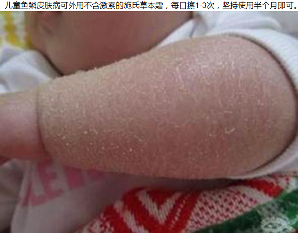 儿童鱼鳞皮肤病 快速解决的小窍门 健康频道 手机搜狐