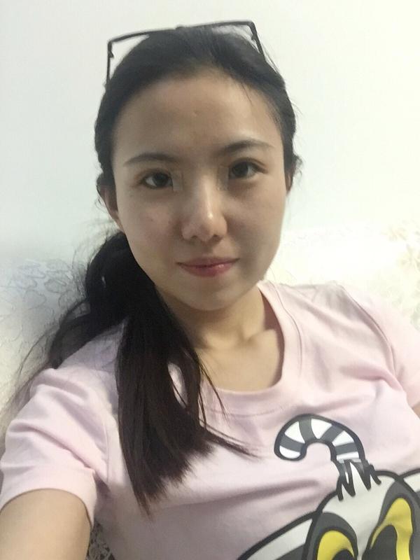 双眼皮恢复期出了点事情 哭得好肿